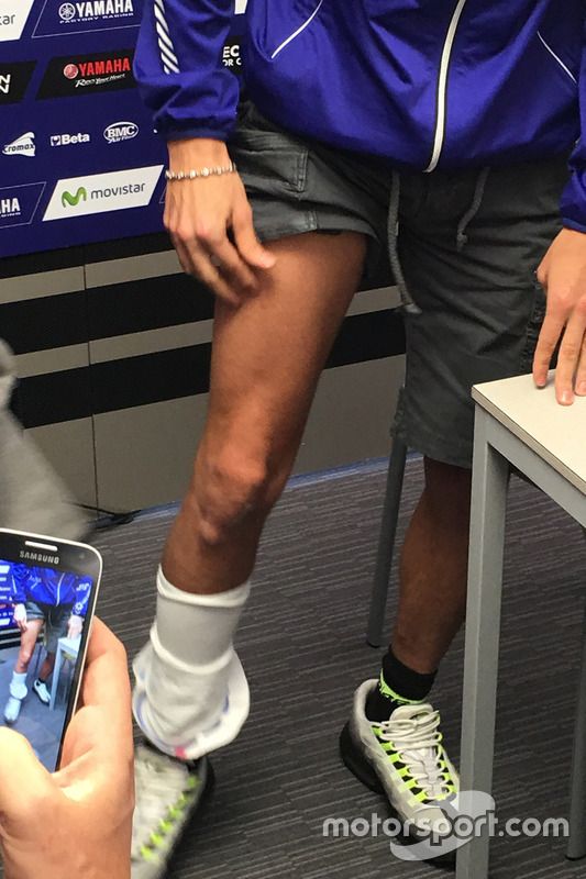 Valentino Rossi muestra su pierna
